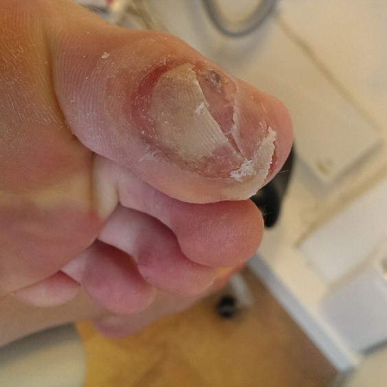 how to care for your feet in badminton